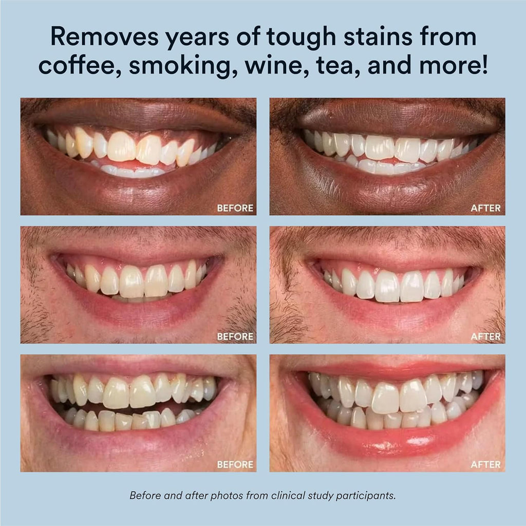 Teeth Whitening Kit, LED Accelerator Light, 35% Carbamide Peroxide Teeth Whitening Gel, 20+ Whitening Treatments, Whitens up to 10 Shades in 7 Days